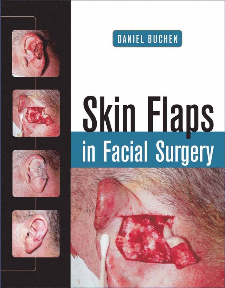 Daniel Buchen - Skin Flaps in Facial Surgery, Inbunden