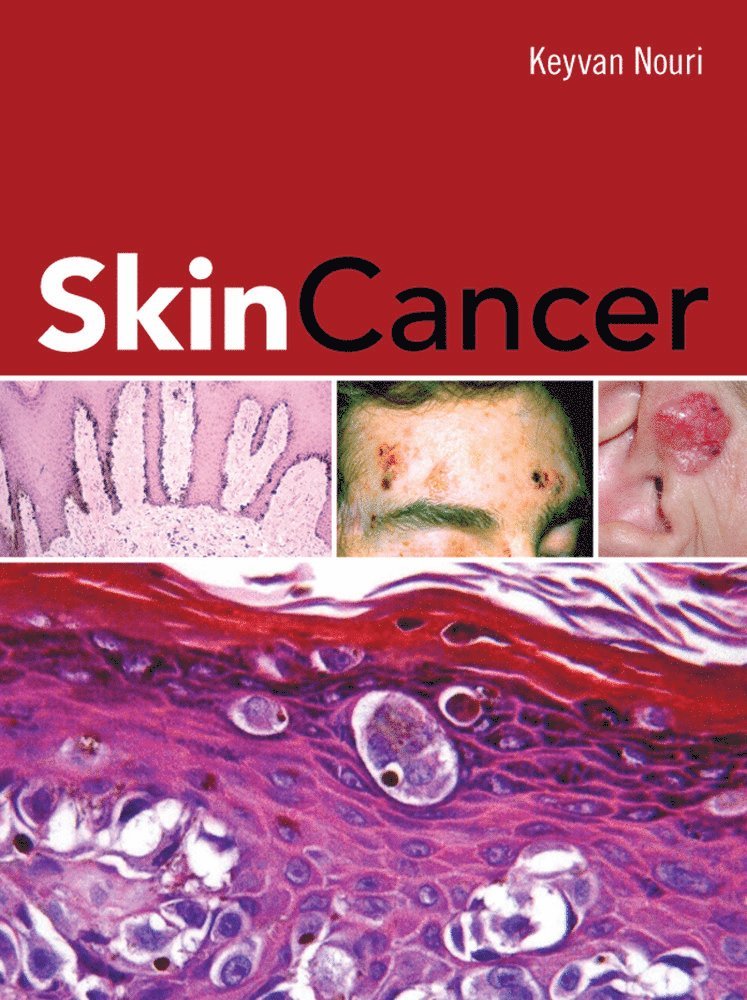 Skin Cancer