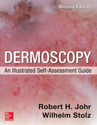 Robert Johr, Wilhelm Stolz - Dermoscopy: An Illustrated Self-Assessment Guide, 2/e, Häftad
