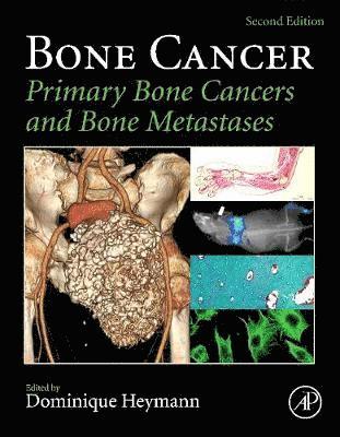 Bone Cancer 1