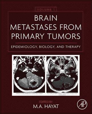 bokomslag Brain Metastases from Primary Tumors Volume 1