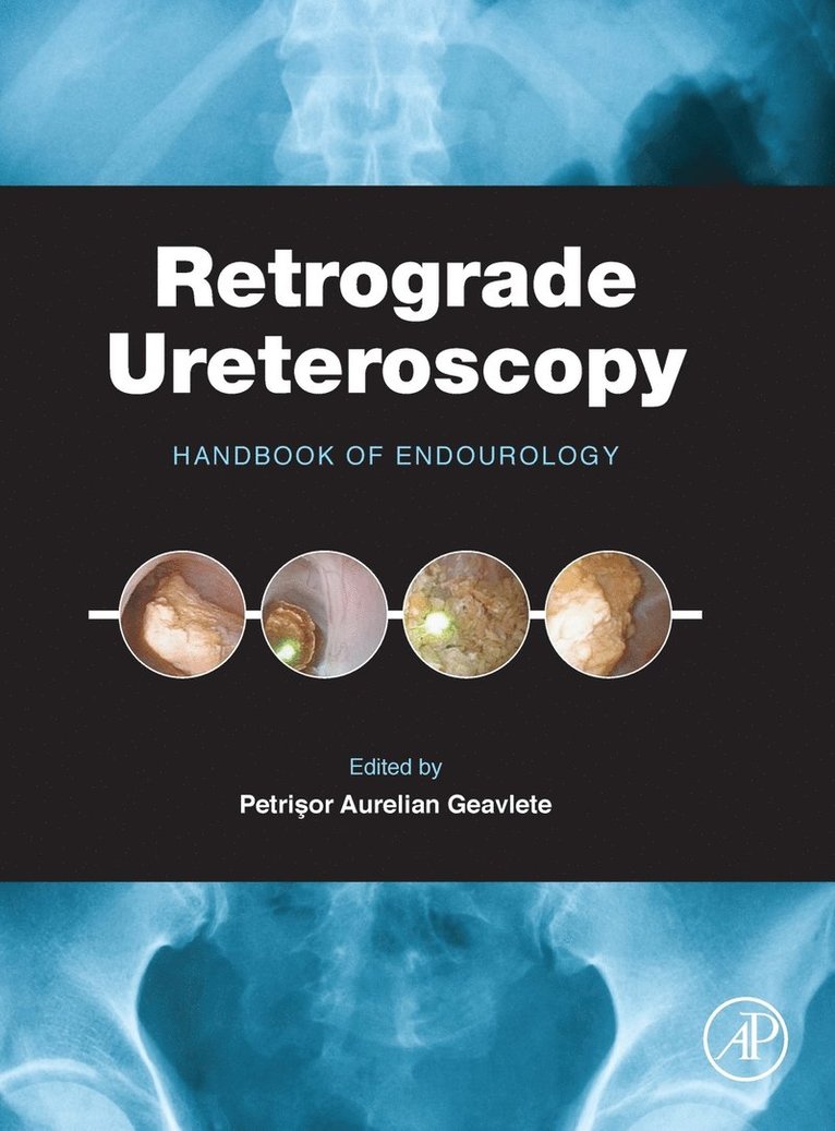 Petrisor Aurelian Geavlete, Romania) Geavlete, Petrisor Aurelian (Department of Urology, Faculty of Medicine, University of Medicine and Pharmacy Carol Davila Bucharest, Bucharest - Retrograde Ureteroscopy, Inbunden