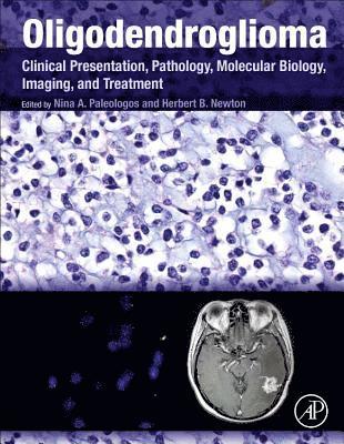 Oligodendroglioma 1