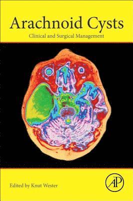 Arachnoid Cysts 1