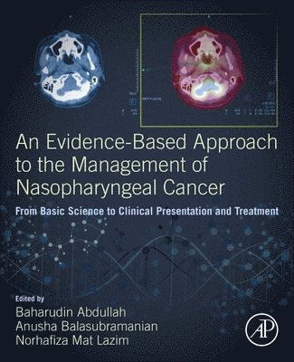 An Evidence-Based Approach to the Management of Nasopharyngeal Cancer 1