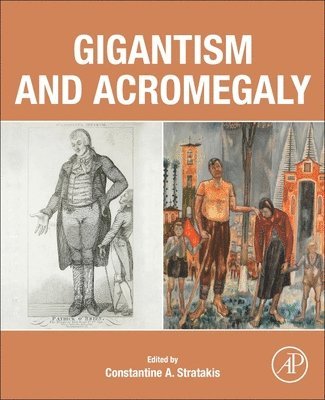 Gigantism and Acromegaly 1
