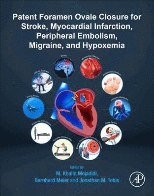 bokomslag Patent Foramen Ovale Closure for Stroke, Myocardial Infarction, Peripheral Embolism, Migraine, and Hypoxemia