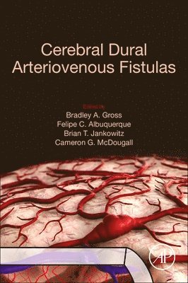 Cerebral Dural Arteriovenous Fistulas 1