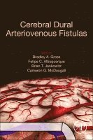 Cerebral Dural Arteriovenous Fistulas