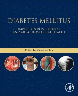 Diabetes Mellitus 1