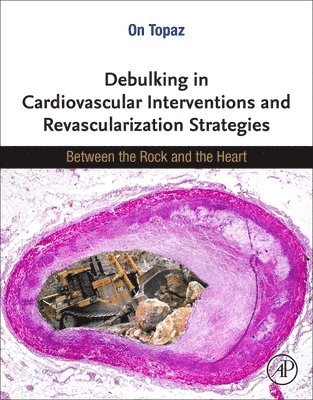 Debulking in Cardiovascular Interventions and Revascularization Strategies 1