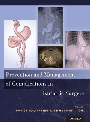 Tomasz G. Rogula, Philip R. Schauer, Tammy Fouse - Prevention and Management of Complications in Bariatric Surgery, Inbunden