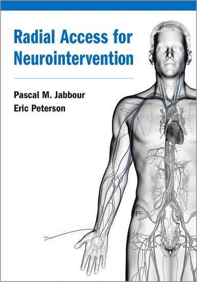 Radial Access for Neurointervention 1