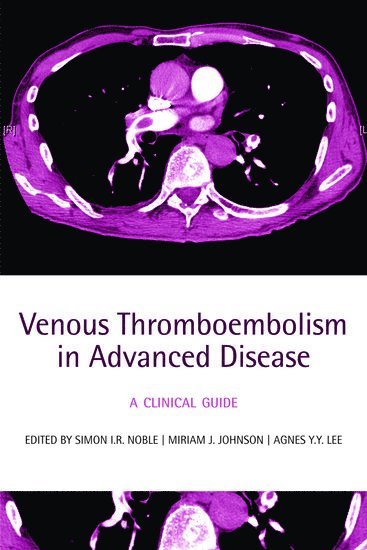 Venous Thromboembolism in Advanced Disease 1