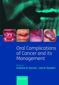 bokomslag Oral Complications of Cancer and its Management