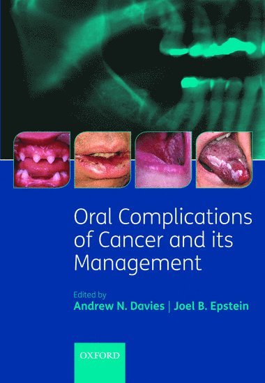 bokomslag Oral Complications of Cancer and its Management