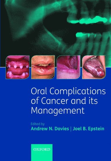 Oral Complications of Cancer and its Management 1
