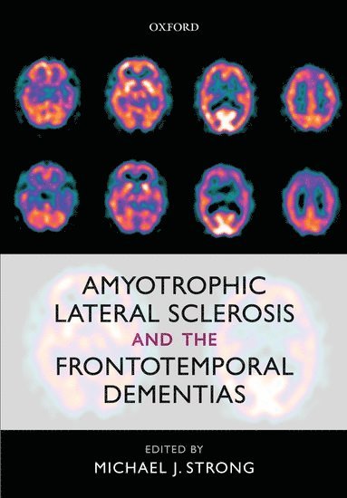 bokomslag Amyotrophic Lateral Sclerosis and the Frontotemporal Dementias