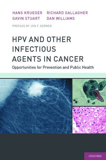 HPV and Other Infectious Agents in Cancer 1