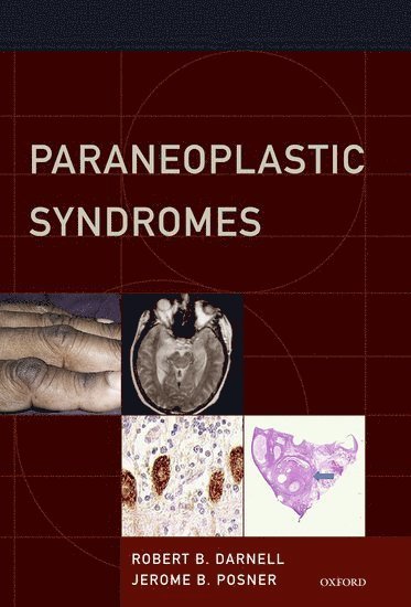 Paraneoplastic Syndromes 1