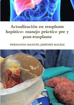 bokomslag Actualizacin en trasplante heptico