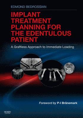 bokomslag Implant Treatment Planning for the Edentulous Patient