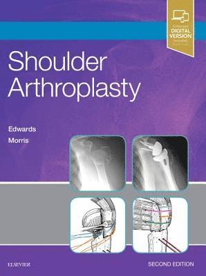 bokomslag Shoulder Arthroplasty