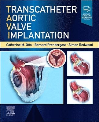 Catherine M. Otto, Bernard D Prendergast, Simon Redwood, Bernard D. Prendergast, Catherine M Otto - Transcatheter Aortic Valve Implantation, Inbunden