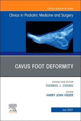 Cavus Foot Deformity, An Issue of Clinics in Podiatric Medicine and Surgery 1