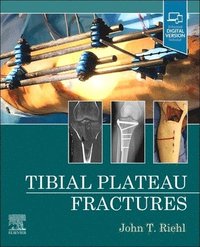 bokomslag Tibial Plateau Fractures