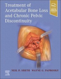 bokomslag Treatment of Acetabular Bone Loss and Chronic Pelvic Discontinuity