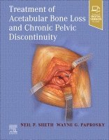 bokomslag Treatment of Acetabular Bone Loss and Chronic Pelvic Discontinuity