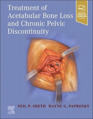 Treatment of Acetabular Bone Loss and Chronic Pelvic Discontinuity 1