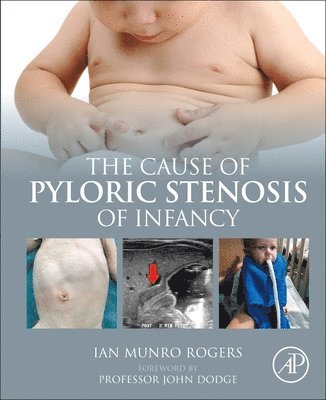 The Cause of Pyloric Stenosis of Infancy 1