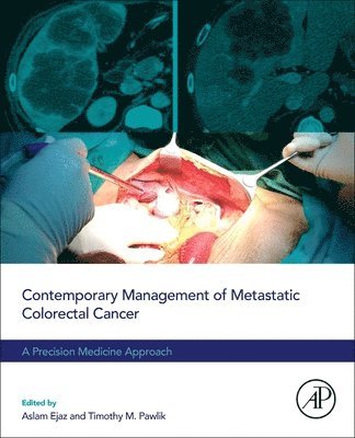 Ejaz,Asla, Aslam Ejaz, Timothy M. Pawlik - Contemporary Management of Metastatic Colorectal Cancer, Häftad