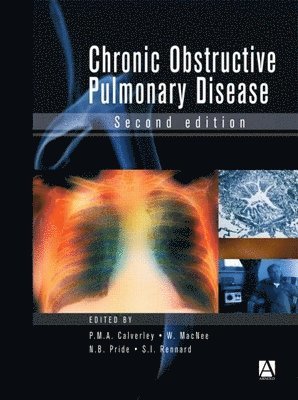 bokomslag Chronic Obstructive Pulmonary Disease