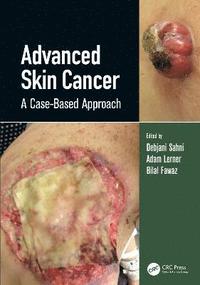 bokomslag Advanced Skin Cancer