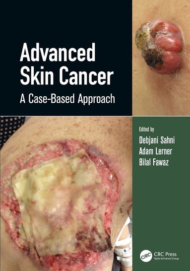 Debjani Sahni, Adam Lerner - Advanced Skin Cancer, Inbunden