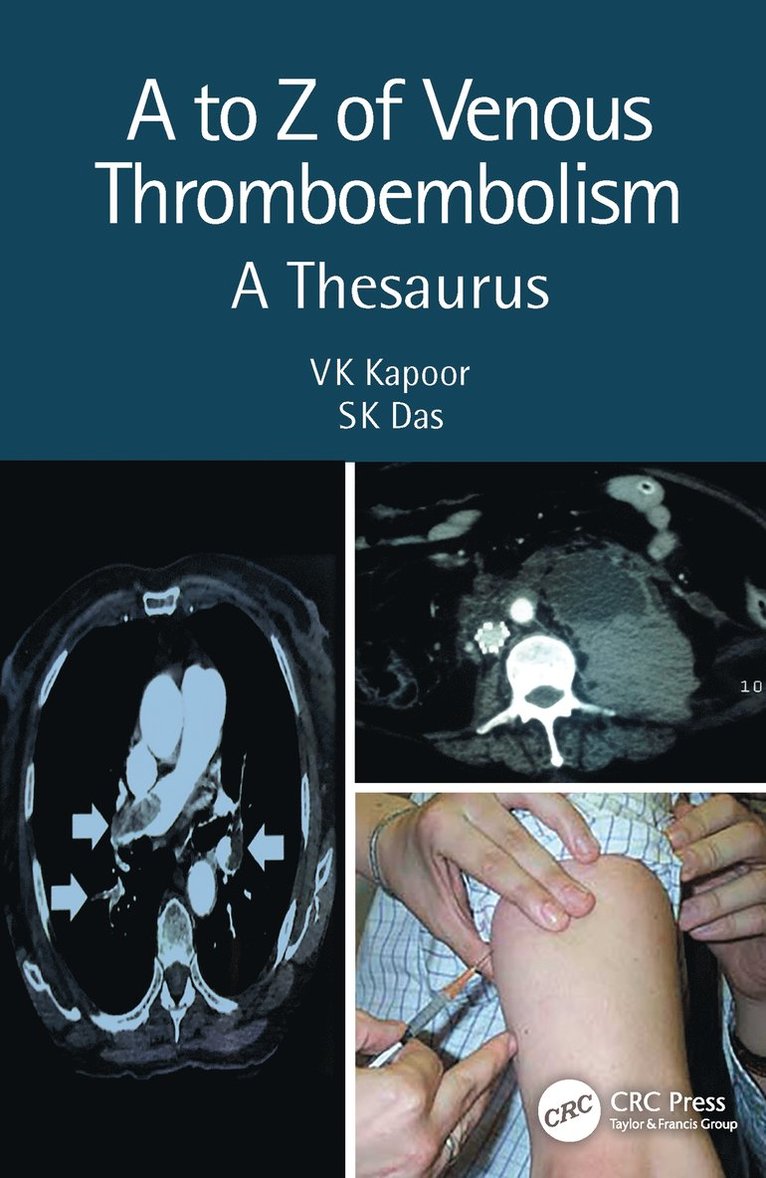 VK Kapoor, SK Das, India) Kapoor, VK (SGPGIMS, Lucknow, London) Das, SK (Brunel University, Vk Kapoor, Sk Das - to Z of Venous Thromboembolism, Häftad