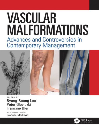 bokomslag Vascular Malformations