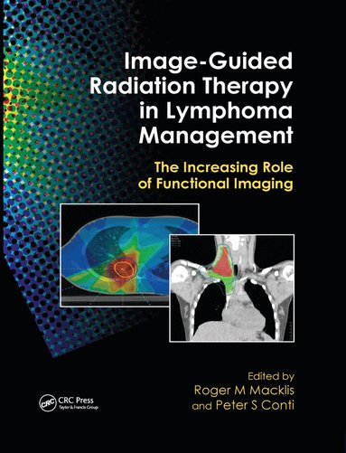 bokomslag Image-Guided Radiation Therapy in Lymphoma Management