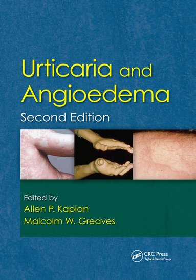 Allen Kaplan, Malcolm Greaves, Allen Kaplan, Malcolm W. Greaves - Urticaria and Angioedema, Häftad