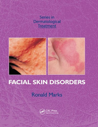 Ronald Marks - Facial Skin Disorders, Häftad