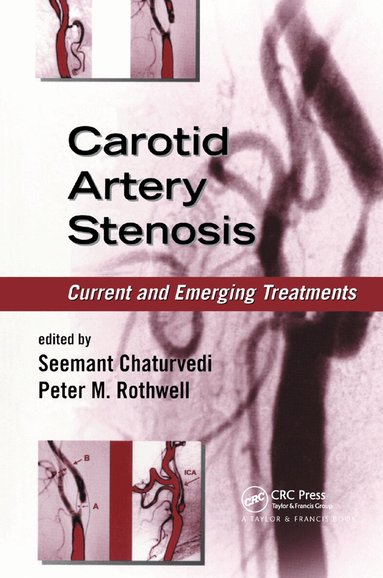 Seemant Chaturvedi, Peter M. Rothwell - Carotid Artery Stenosis, Häftad