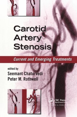 Carotid Artery Stenosis 1