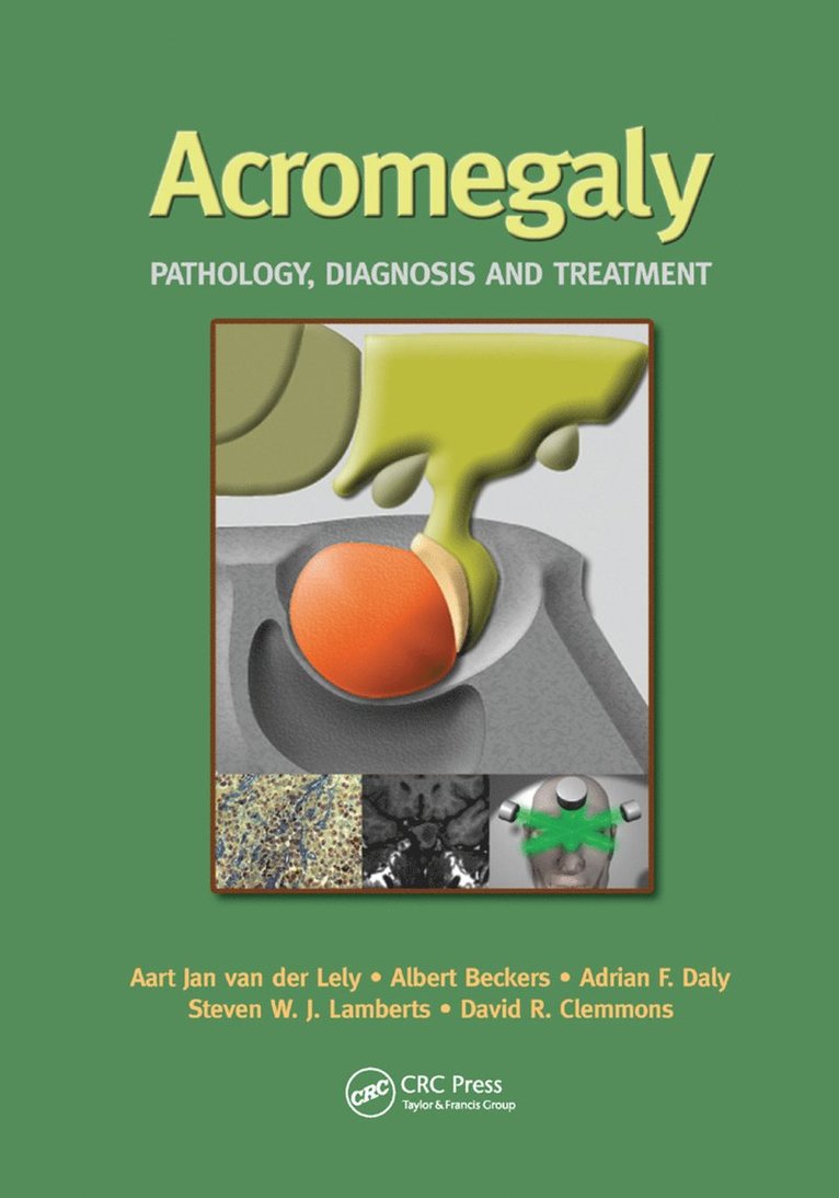 Acromegaly 1