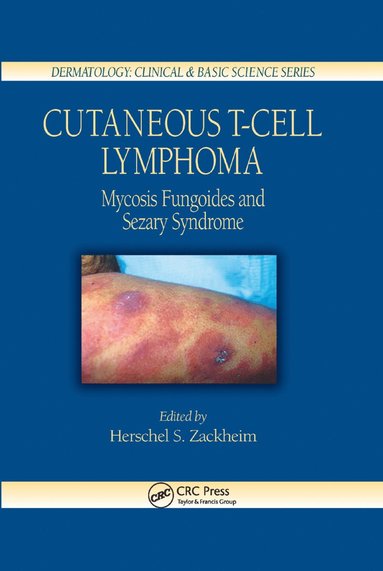 bokomslag Cutaneous T-Cell Lymphoma