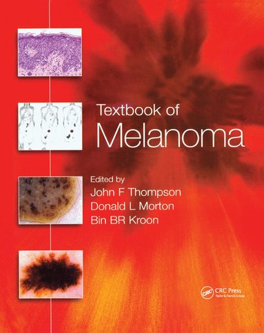 John F. Thompson, Donald L. Morton, Bin B.R. Kroon - Textbook of Melanoma, Häftad