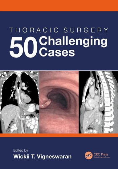 Wickii Vigneswaran - Thoracic Surgery: 50 Challenging cases, Inbunden