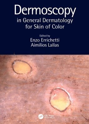 Dermoscopy in General Dermatology for Skin of Color 1